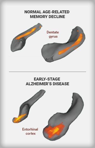 An infographic that shows changes in a specific part of the brain’s hippocampus