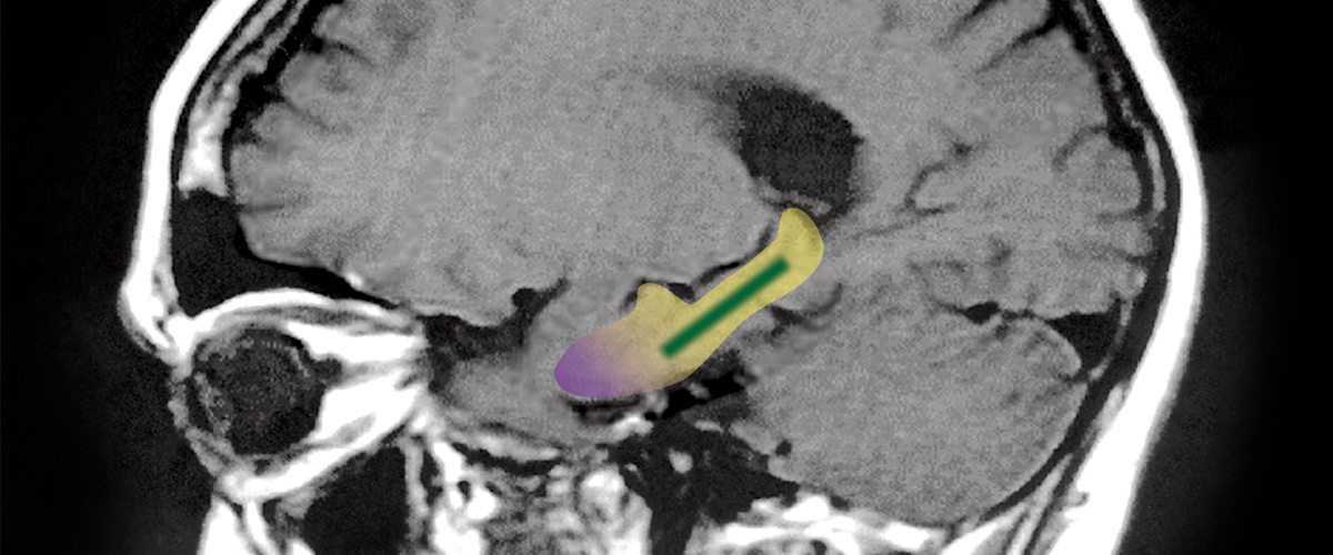 An MRI image of the human brain