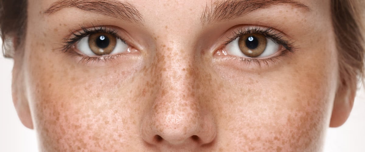 Close up of a woman's freckled face
