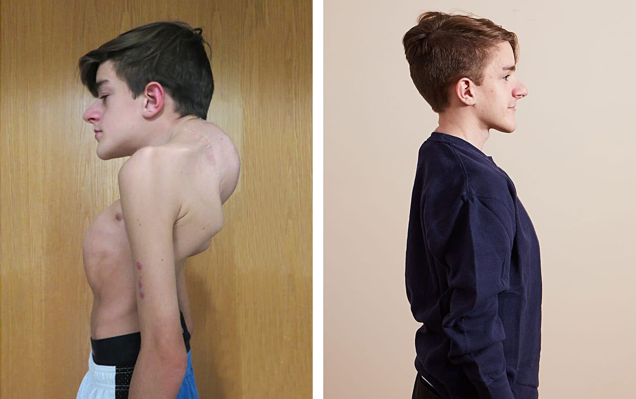 John Sarcona through different stages of scoliosis