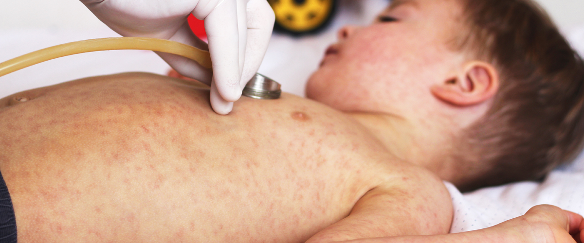 A child with measles being examined